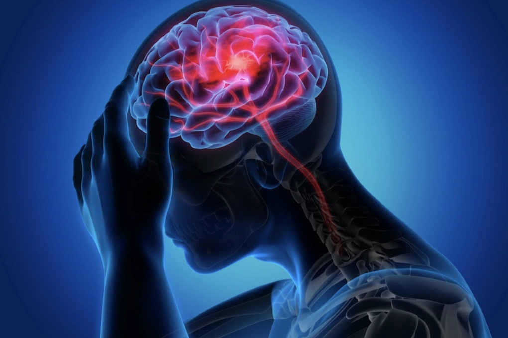 Đột Quỵ Thường Xảy Ra Vào Những Thời Điểm Nào Trong Ngày?