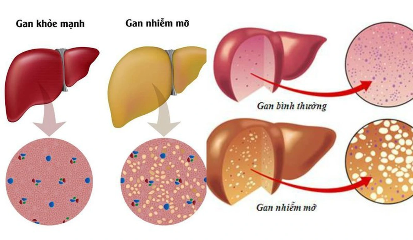 Cảnh Giác Với Hai Biến Chứng Nguy Hiểm Của Gan Nhiễm Mỡ