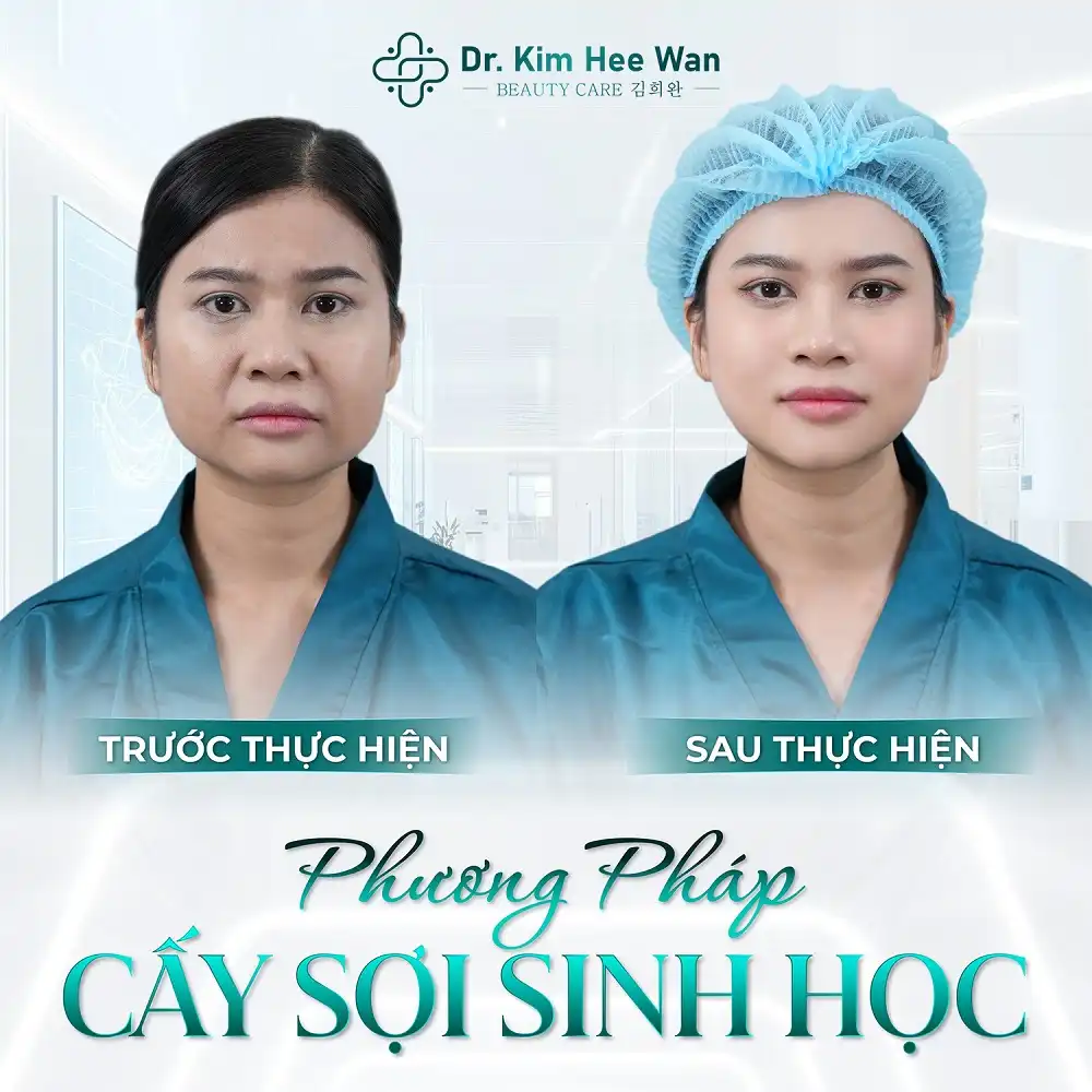 Trẻ hoá làn da bằng Cấy sợi sinh học Diamond Lift