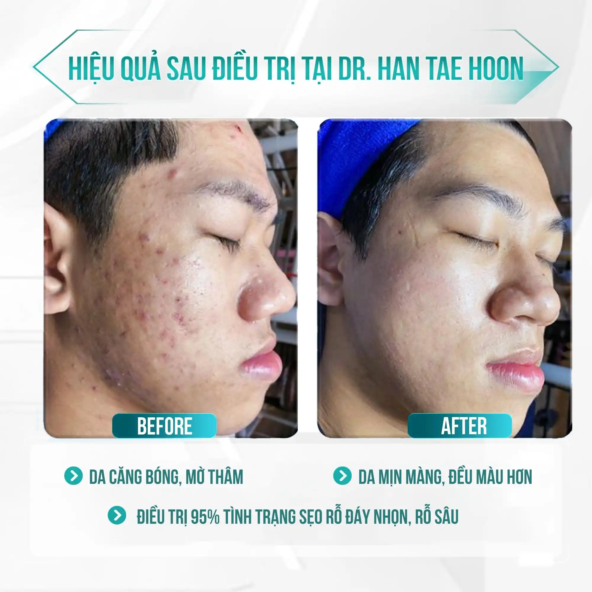 Siêu công nghệ trị sẹo Sylfirm: Giải pháp tái sinh làn da tại Viện Dr. Han Tae Hoon